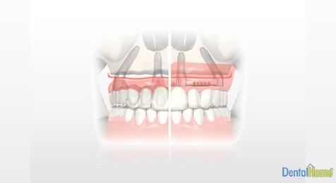 all on four implants