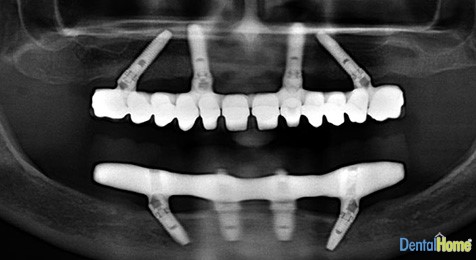 all on four implants