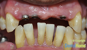 coronas-e-implantes-dentales-medellin-dental-home-antes-1