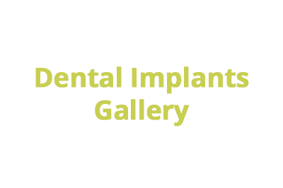 gallery dental-implants-teeth-tooth-colombia