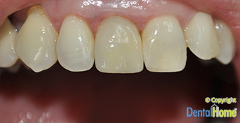 implante-dental-central-despues-1