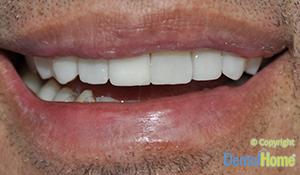 implante-dental-central-medelllin--caso3a-despues