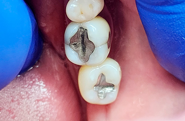 Antes del Reemplazo de amagalmas-por-resinas