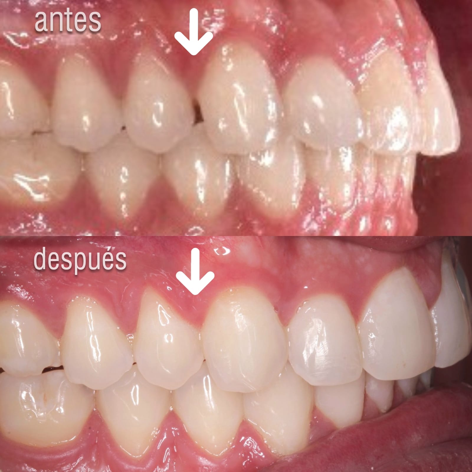 comparacion resultados alineadores-dentales-antes y despues