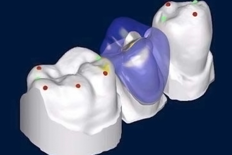 cad cam technology for crowns