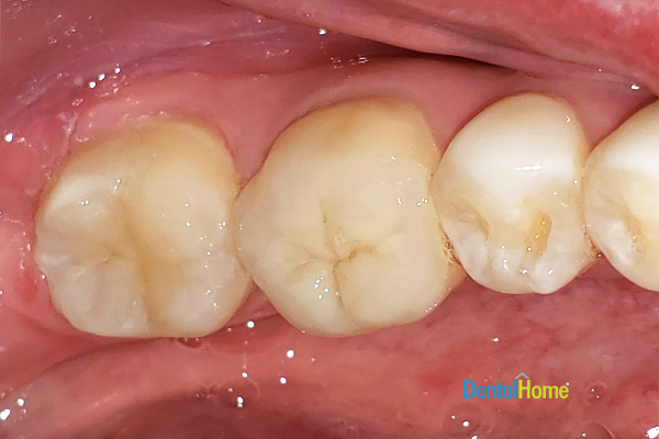 caso 2 cambio-de-amalgamas-por-resinas-en-medellin. Después del cambio