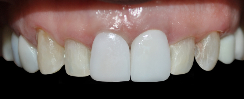 clinica implantes dentales medellin 3