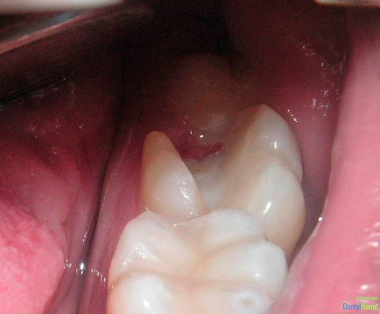 dental inlays case 1 before