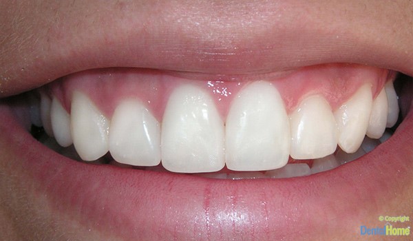 resin veneers example in medellin