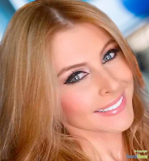 Estética Dental, diseño de sonrisa en medellin