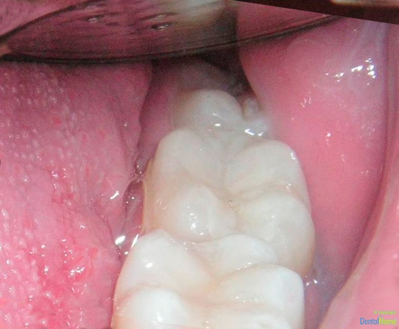 carillas-en-resina-medellin-estetica-dental-home-despues-caso-2