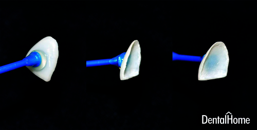 lentes de contacto dental medellin ceramicos