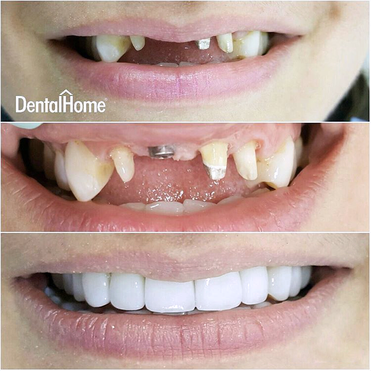 Implantes dentales Medellin