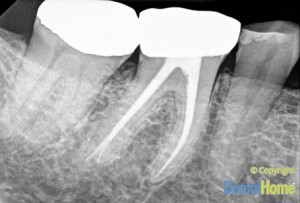 endodoncia medellin