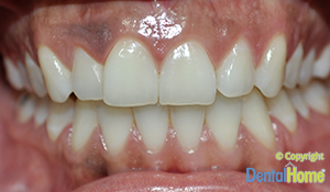 blanqueamiento-de-encias-medellin-dental-home-antes