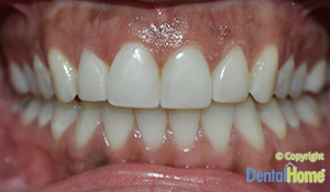 blanqueamiento-de-encias-medellin-dental-home-despues-1