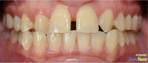 carillas-con-resina-en-colombia-clinica-dental-home-antes-caso-7