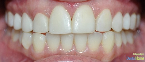 carillas-con-resina-en-colombia-clinica-dental-home-despues-caso-7