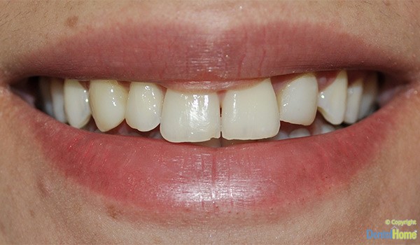 carillas-en-resina-medellin-estetica-dental-home-antes-caso-2