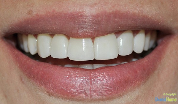 carillas-en-resina-medellin-estetica-dental-home-despues-caso-2