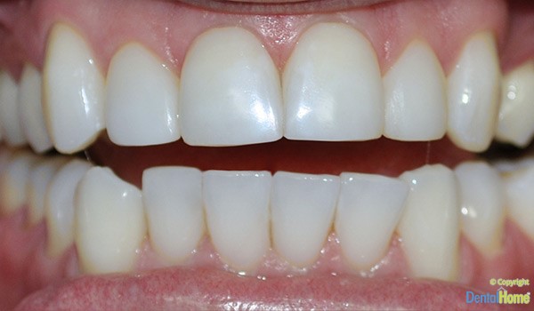 carillas-resina-medellin-clinica-dental-home-despues-caso-6