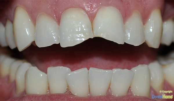 carillas-resina-medellin-clinica-dental-home-despues-caso-6