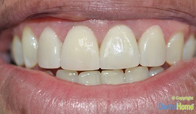 corona-dental-en-zirconio-medellin-antes-1