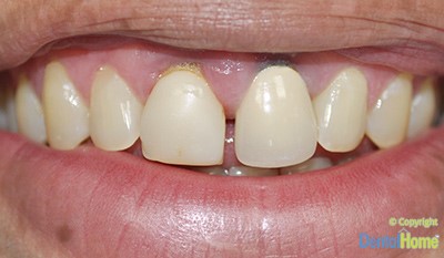 corona-dental-en-zirconio-medellin-despues-1