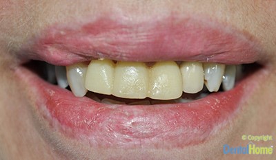 coronas-dentales-y-puentes-dentales-fijos-medellin-antes-1