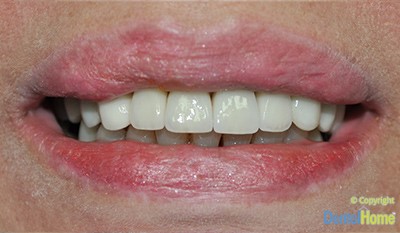 coronas-dentales-y-puentes-dentales-fijos-medellin-despues-1