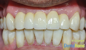 coronas-e-implantes-dentales-medellin-dental-home-despues-1