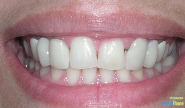 coronas-y-puentes-dentales-medellin-caso-5-antes