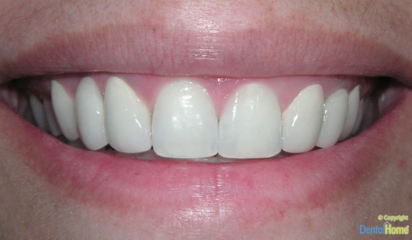 coronas-y-puentes-dentales-medellin-caso-5-despues