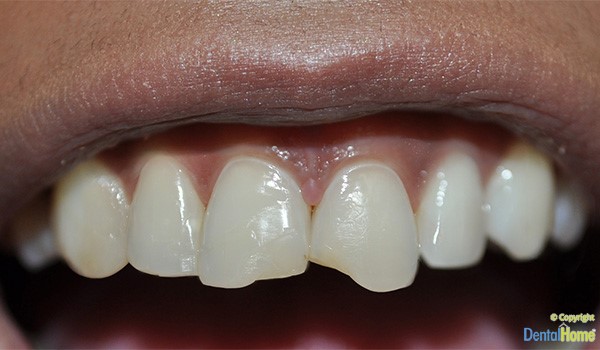 correccion-de-fractura-con-carilla-antes