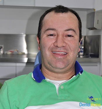 testimonio de robert barrios sobre lentes de contacto dental en medellin, colombia