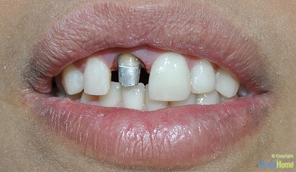 dientes-con-coronas-en-zirconio-dental-home-caso-4-antes