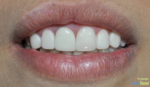 dientes-con-coronas-en-zirconio-dental-home-caso-4-despues