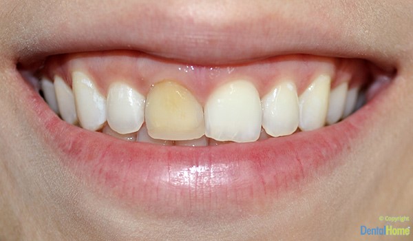 estetica-dental-carillas-en-resina-correcion-color-antes-1