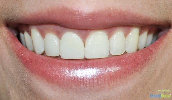 estetica-dental-carillas-en-resina-correcion-color-despues-1