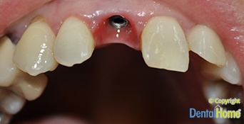 implante-dental-central-antes-1