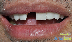 implante-dental-central-medelllin--caso3a-antes