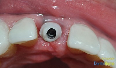 implante-dentales-en-medelllin-caso3c-dental-home-despues