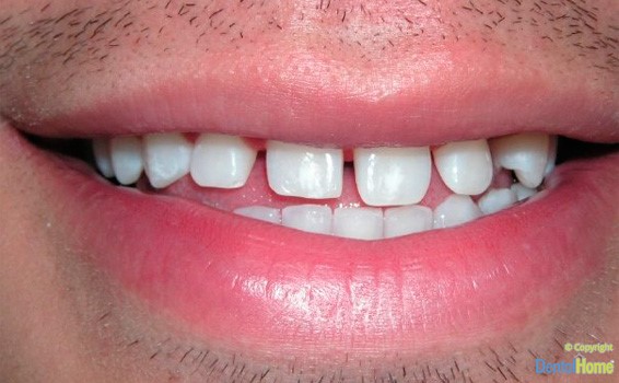 lentes-de-contacto-dentales-en-medellin-dental-home-caso-8-antes