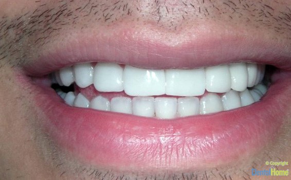 lentes-de-contacto-dentales-en-medellin-dental-home-caso-8-despues