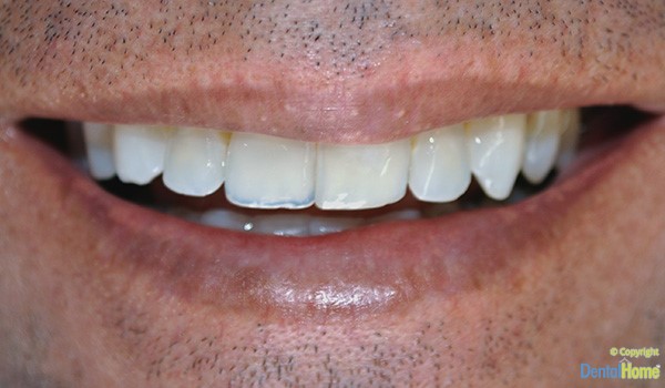 lentes-de-contacto-dentales-medellin-dental-home-caso-2-antes