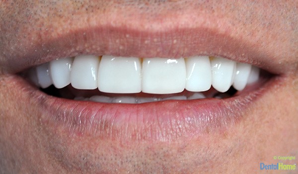 lentes-de-contacto-dentales-medellin-dental-home-caso-2-despues