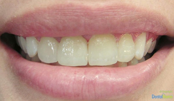 lentes-de-contacto-para-dientes-medellin-dental-home-caso-3-antes