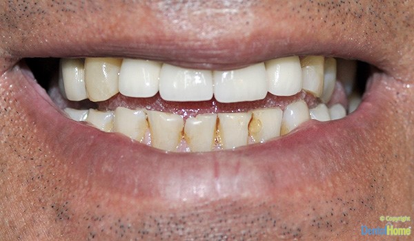 odontologos-coronas-dentales-en-medellin-dental-home-caso-6-antes