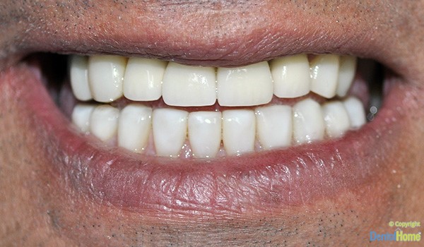 odontologos-coronas-dentales-en-medellin-dental-home-caso-6-despues