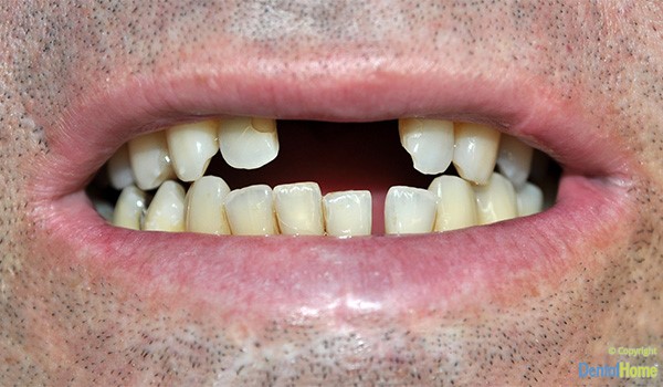 puentes-dentales-medellin-para-dientes-caso--3-antes